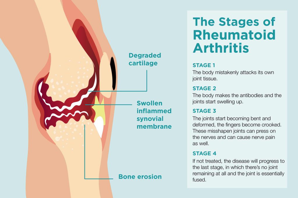The stages of Rheumatoid Arthritis