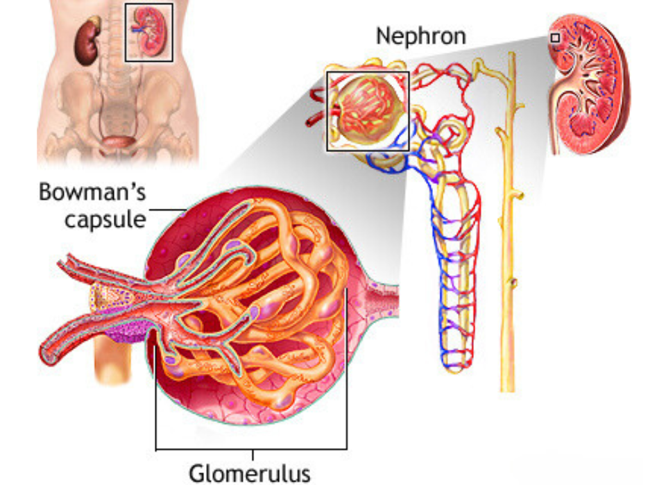 IgA Nephropathy - a common form of glomerular disease