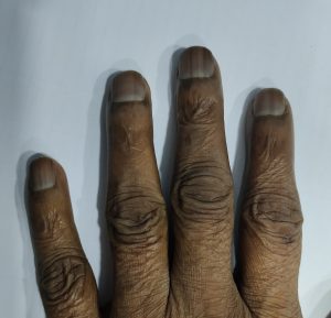 Half and half nails, a skin symptom in kidney disease