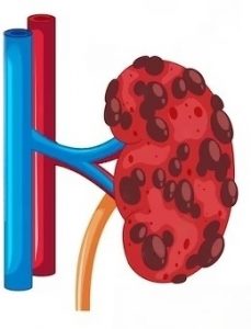 Polycystic kidney disease