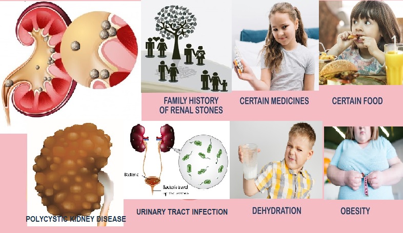 Conditions that accelerate the formation of kidney stones in children