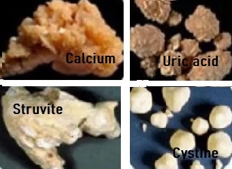 Types of Kidney stones