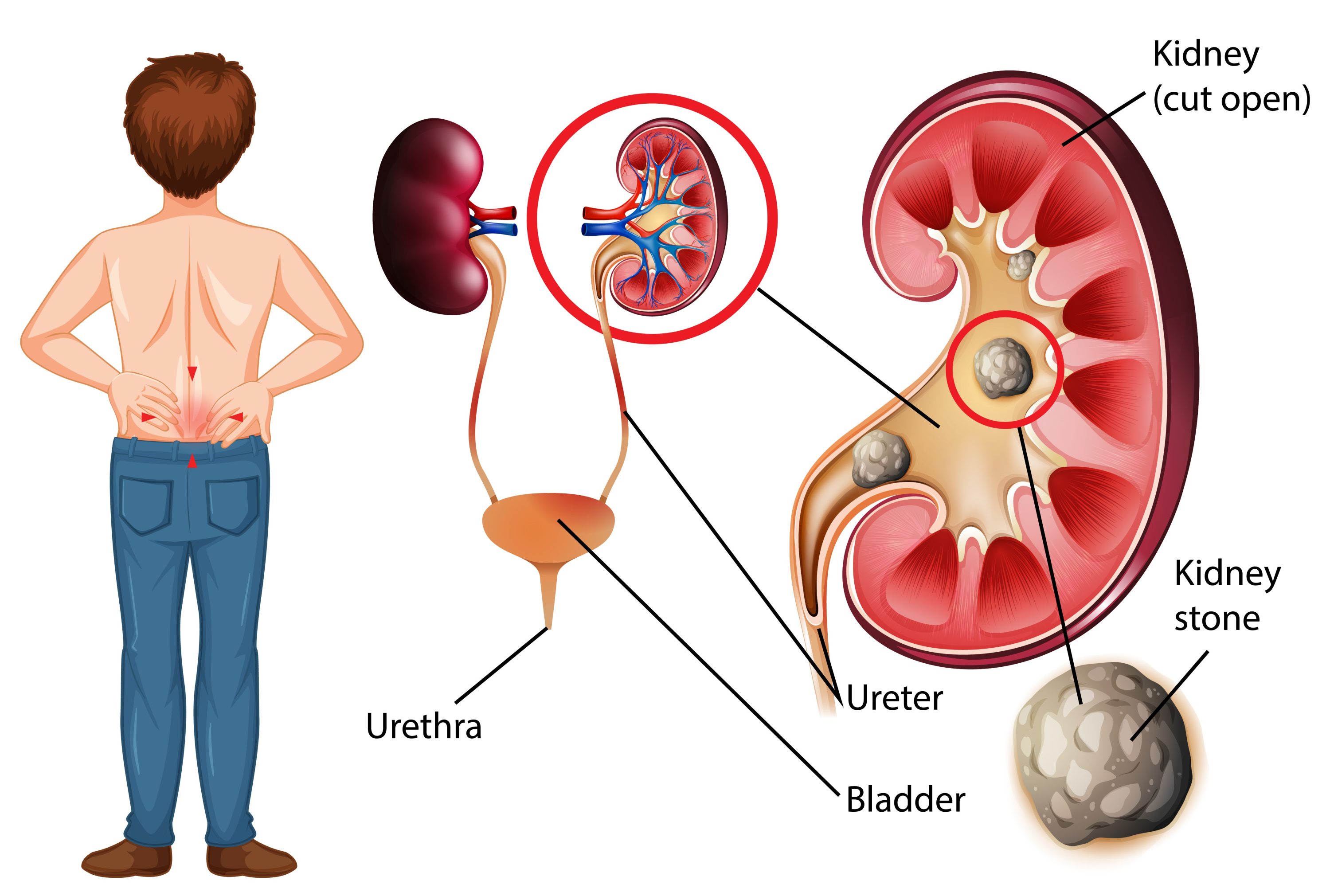 Kidney stone, reason of shrunken kidney