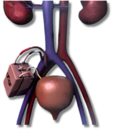 artificial kidney