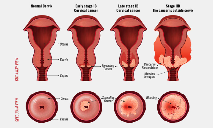 Diethylstilbestrol (DES) - a known endocrine disrupter causes cervical cancer (Source: D.E.S is it )