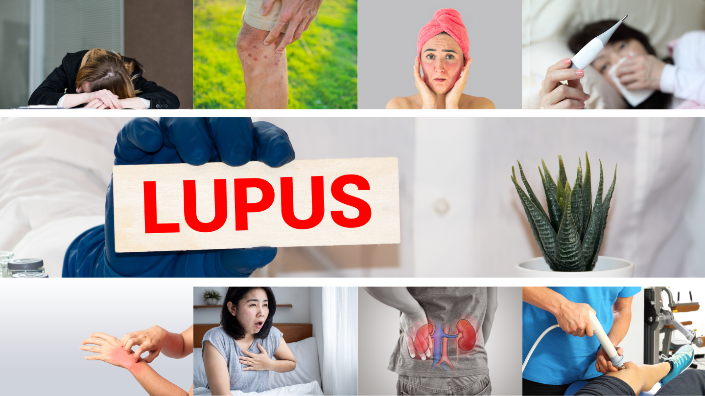 Symptoms of Lupus