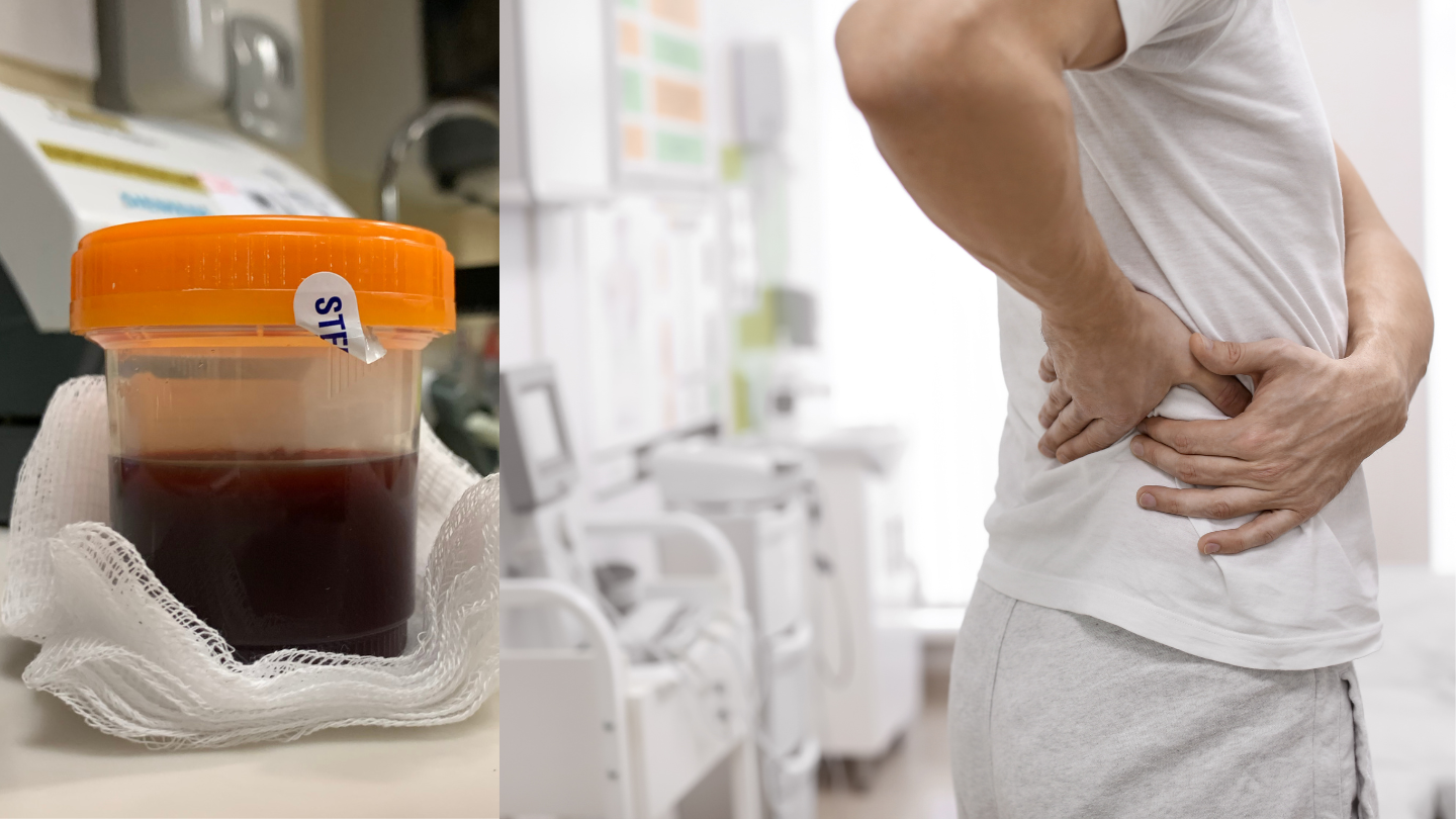 Hematuria and back pain