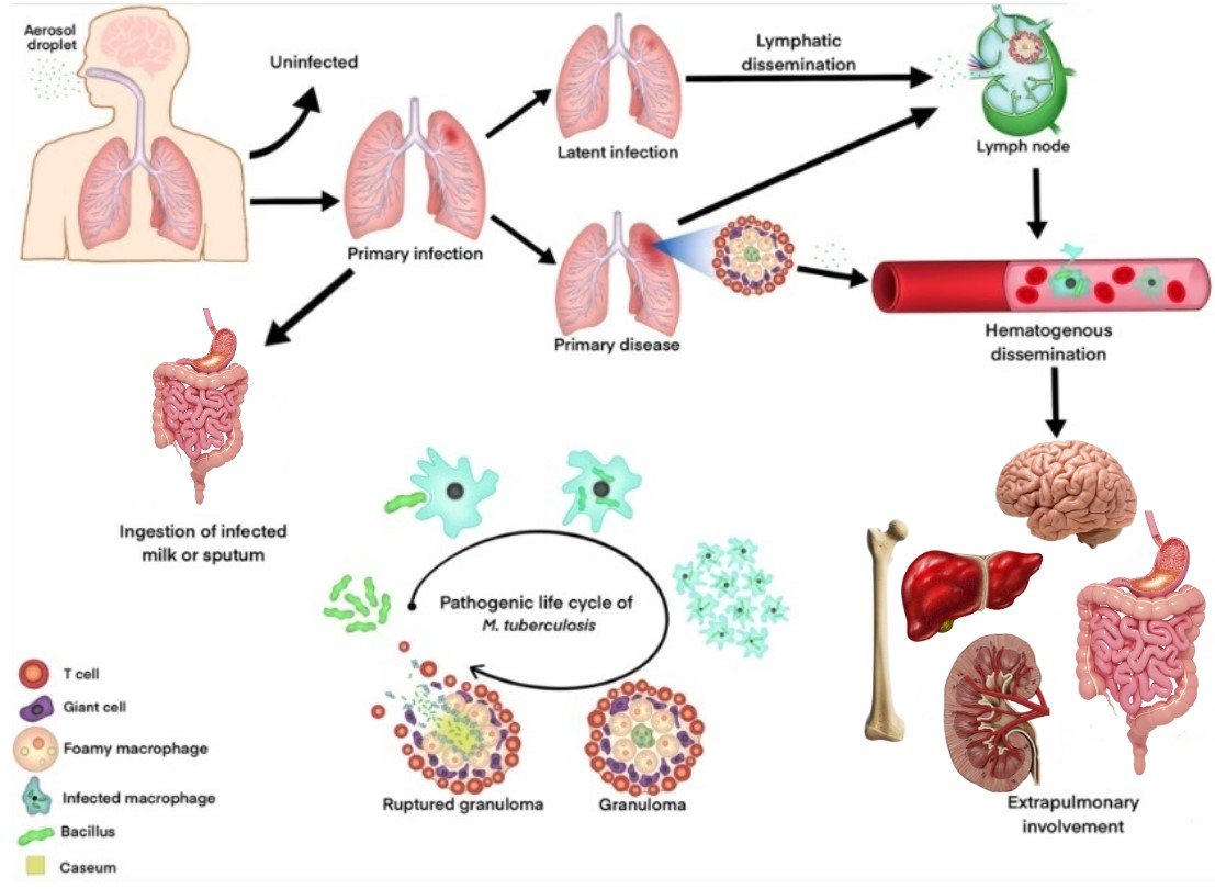 Extrapulmonary tuberculosıs