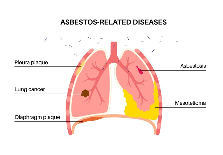 Risk of lung cancer