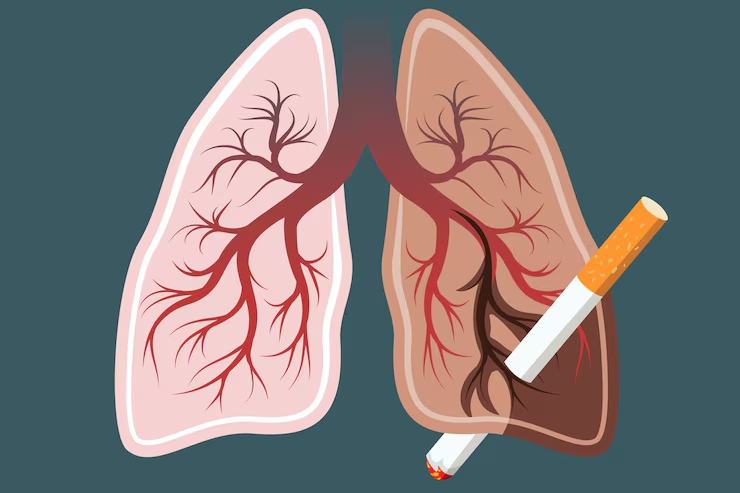 Risk of Lung cancer